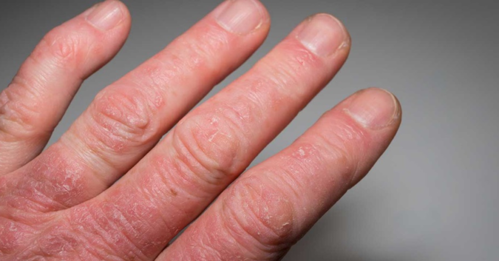 Psoriatic Arthritis